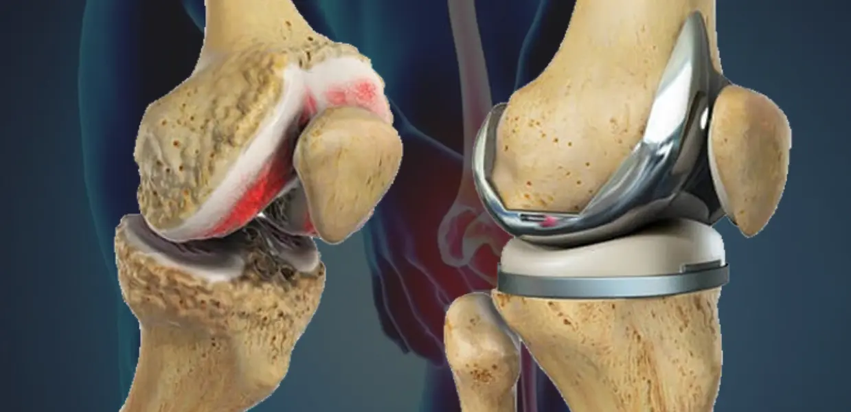 Knee & Hip Replacement in India for Zimbabwe Patients